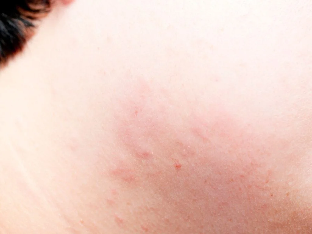 punaises de lit piqure