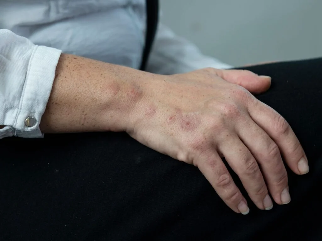 punaises de lit piqure