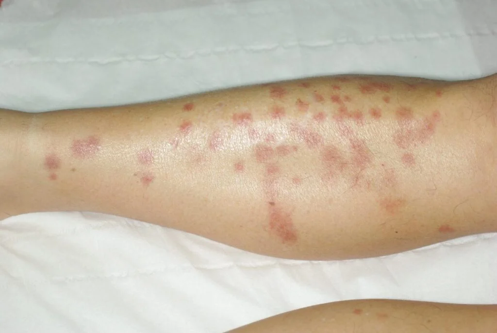 punaise de lit paris