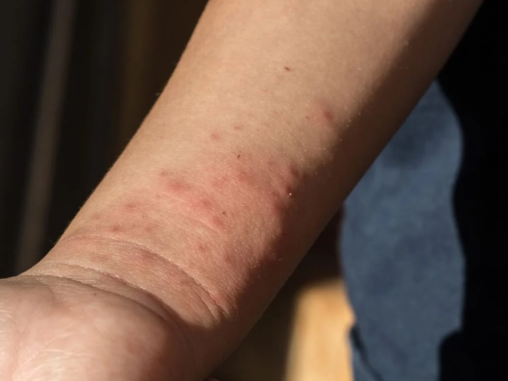 punaises de lit piqure