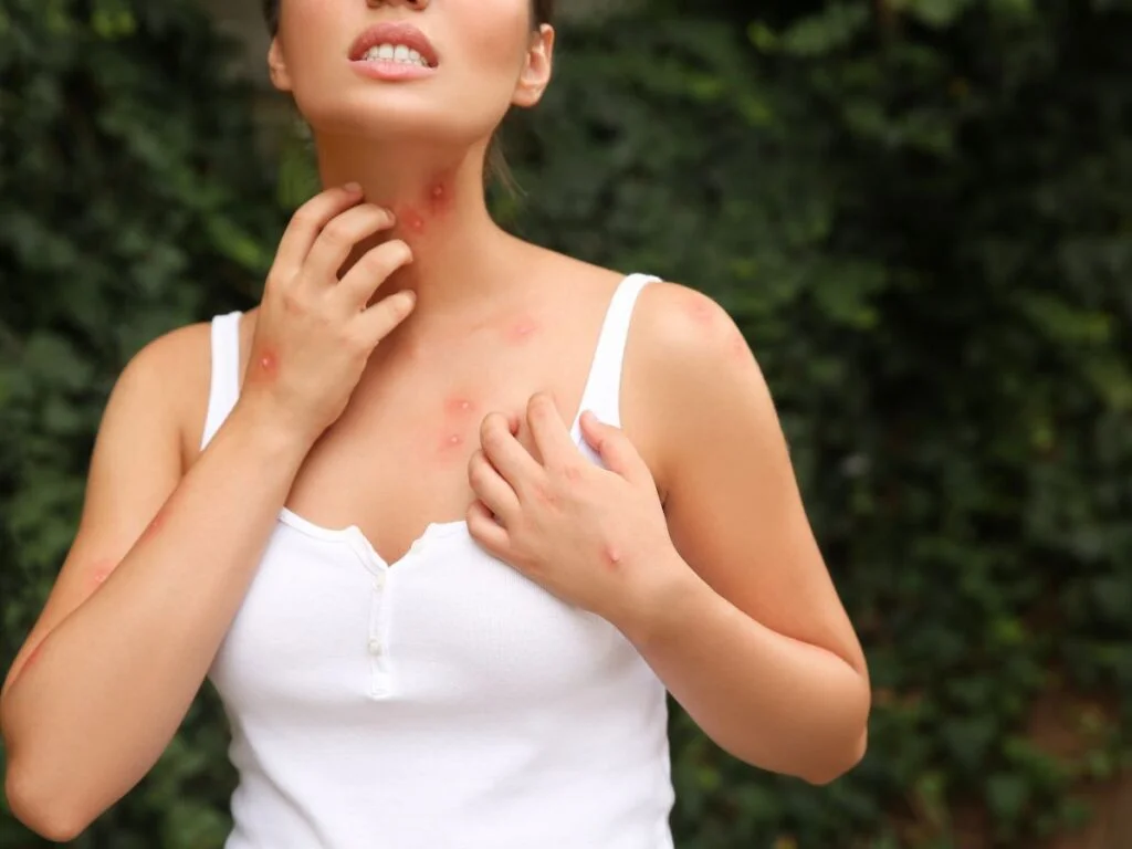 punaises de lit piqure